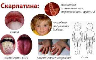 Скарлатина — инкубационный период, карантин, лечение