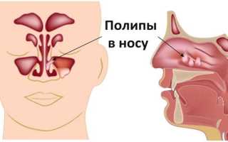 Отчего появляются кровянистые выделения из носа и распространенные ошибки при лечении