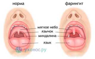 Воспаление задней стенки горла, кашель и температура: как и чем лечить