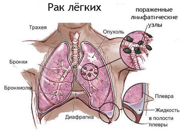 Боль в правом подреберье при кашле причины и возможные заболевания
