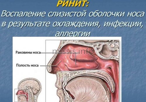 Что такое ринит