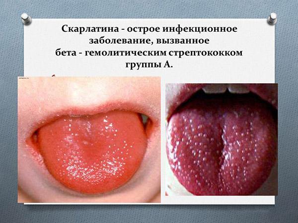 Что такое скарлатина