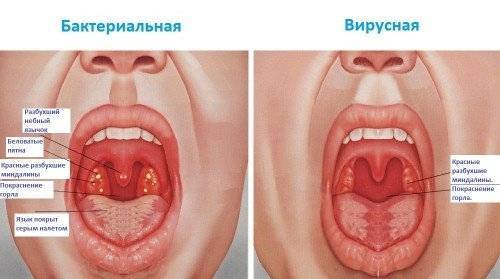 Флемоксин при ангине как принимать при тонзиллите инструкция по применению