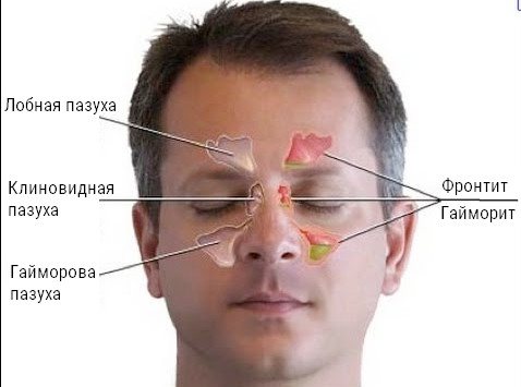 Гайморит и фронтит