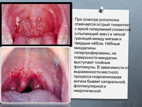 Глотка при скарлатине