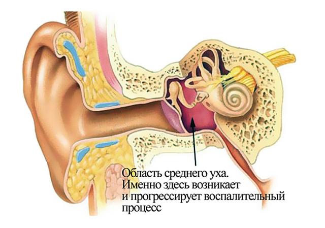 хронический отит