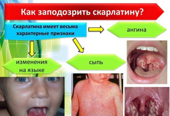 Как распознать скарлатину
