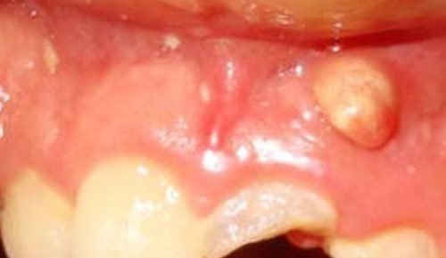 Киста на слизистой десны