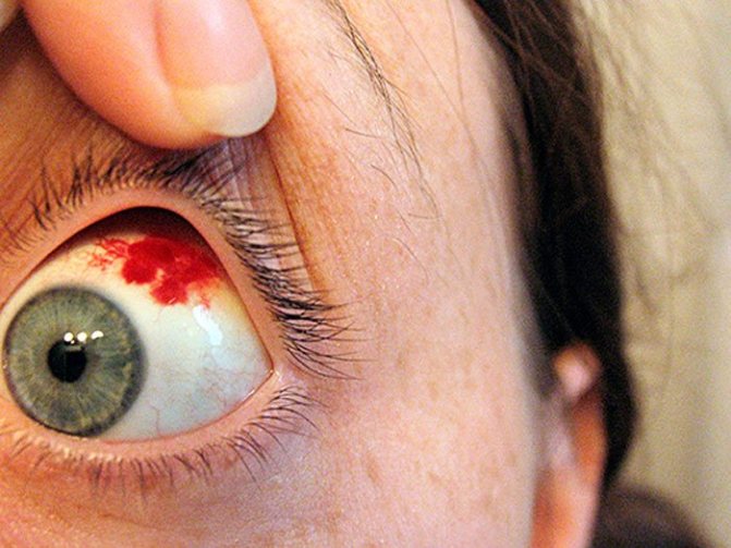 Кровоизлияния в области глаза