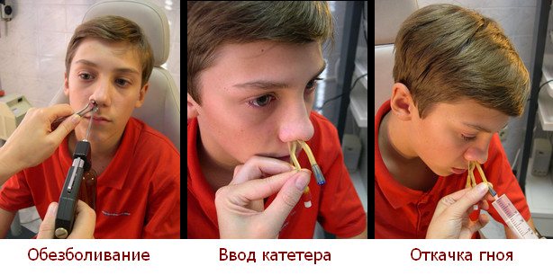 Лечение синусита синус катетером ямик
