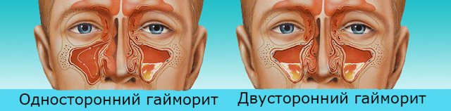Левосторонний и правосторонний гайморит: симптомы и лечение