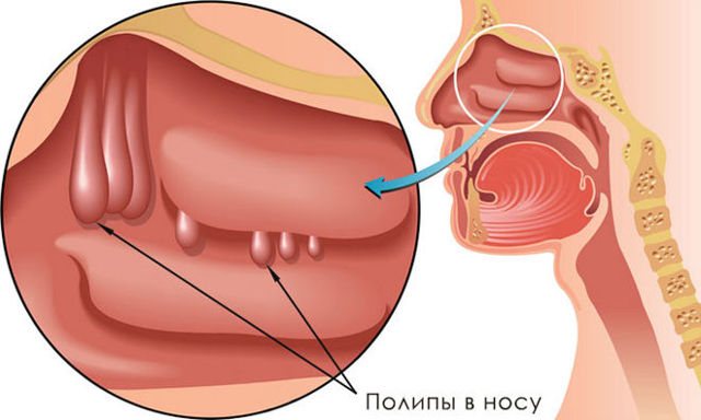 Левосторонний и правосторонний гайморит: симптомы и лечение