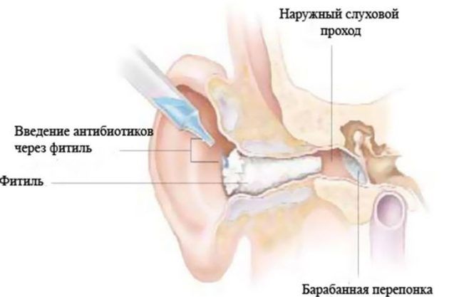 На рисунке показан процесс проведения комплексной терапии при отите