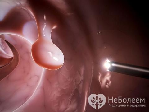 Одна из причин развития болезни – полипы в носу