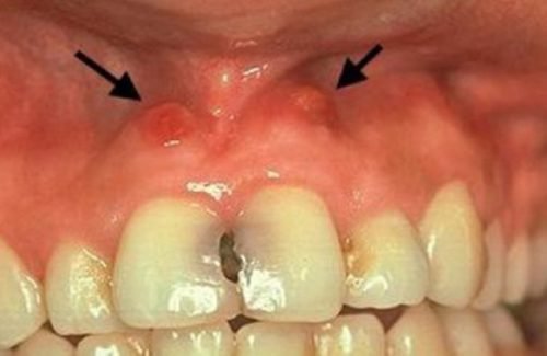 Периодонтит центральных резцов