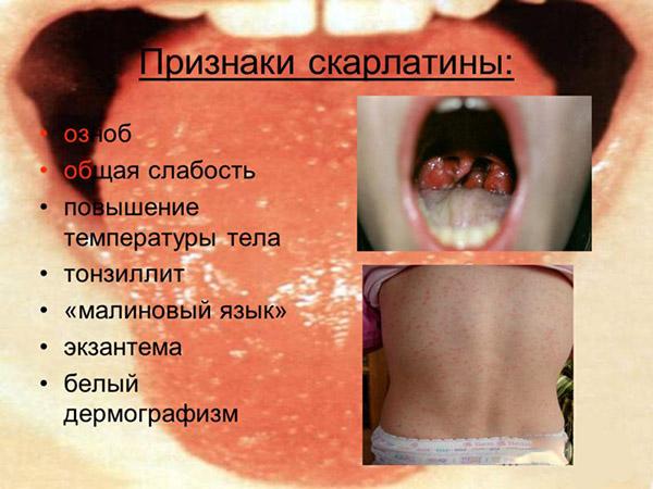 Признаки скарлатины