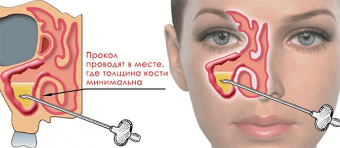 симптомы и лечение одностороннего гайморита