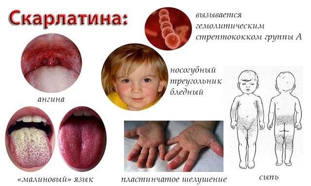 Симптомы и признаки скарлатины