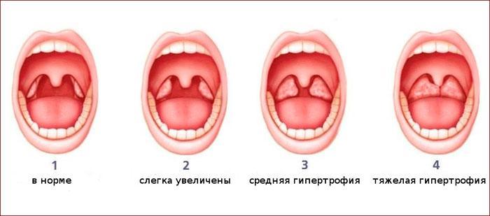 степени гипертрофии миндалин