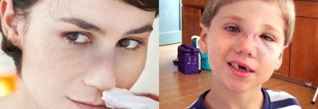 Ушиб носа у взрослого и ребенка