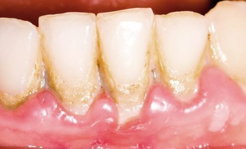 Зубной налет