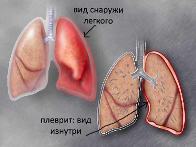 Если болит правый бок и отдает в спину как лечить