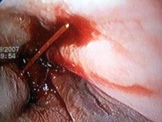 Почему болит за ребрами в спине