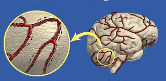 боли при внутричерепном давлении
