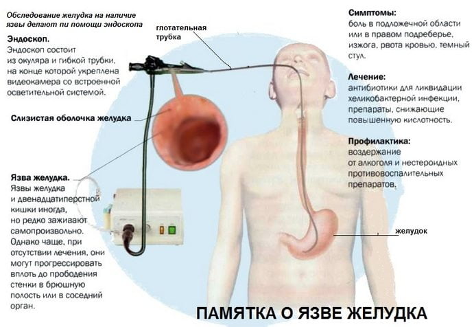 Основная информация о язве желудка у человека Памятка о язве желудка