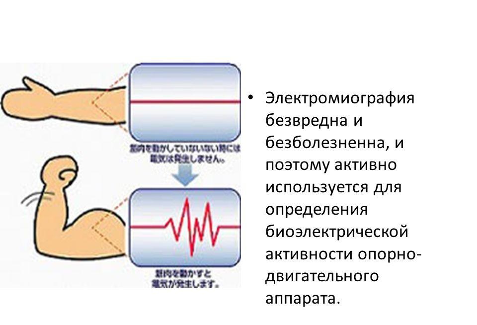 Электромиография