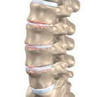 Остеохондроз