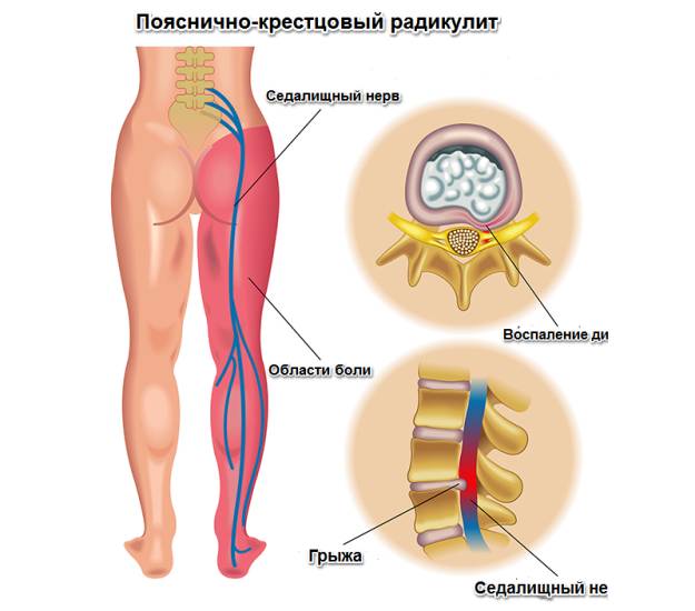 Болит спина болезни позвоночника