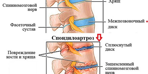 Болит спина болезни позвоночника