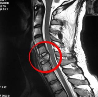 Хрустнула спина теперь болит что делать