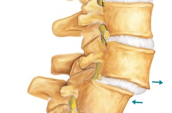 Хрустнула спина теперь болит что делать