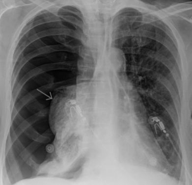 Если болит правый бок и отдает в спину как лечить