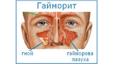 От чего может болеть спина и быть температура