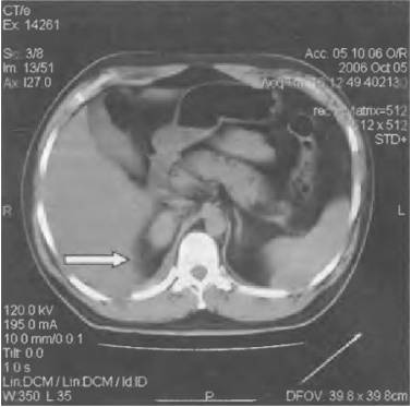 Если болит правый бок и отдает в спину как лечить
