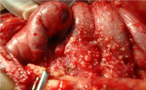 Гнойный перитонит