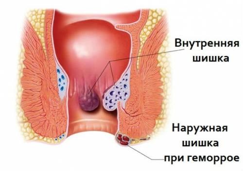 Болит копчик когда садишься на спину