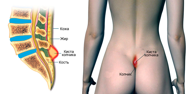 Болит копчик когда садишься на спину