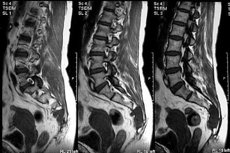 Болит копчик когда садишься на спину