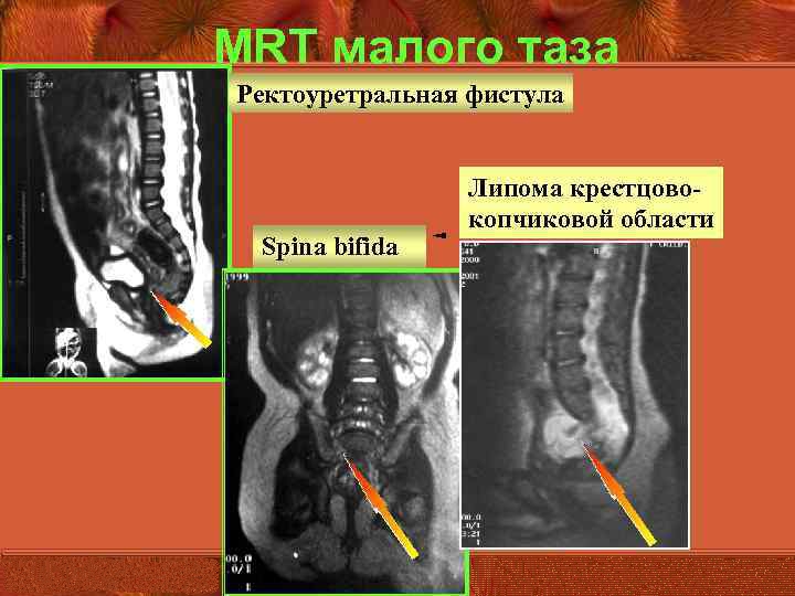 Болит копчик когда садишься на спину