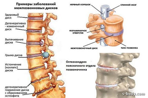 Почему при приседании болит спина
