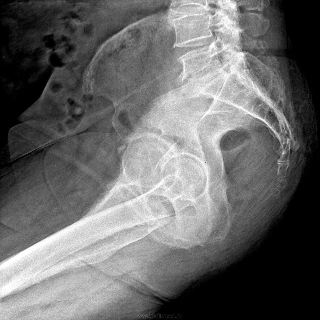 Болит копчик когда садишься на спину